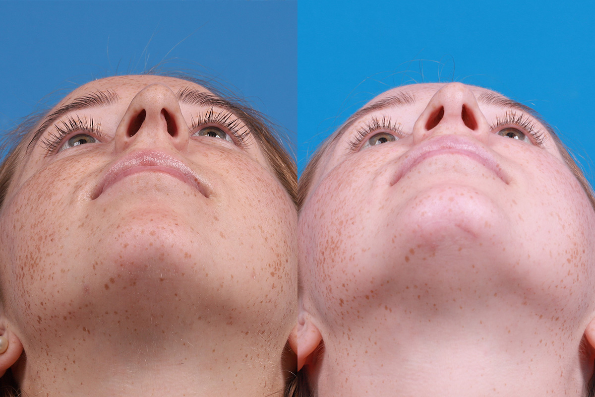 Chin Augmentation Before & After Gallery - Patient 137533 - Image 6