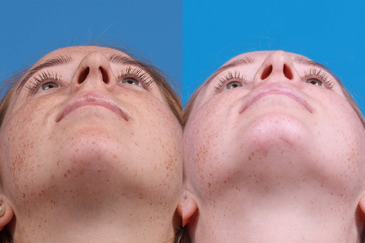 Chin Augmentation Before & After Gallery - Patient 137533 - Image 6