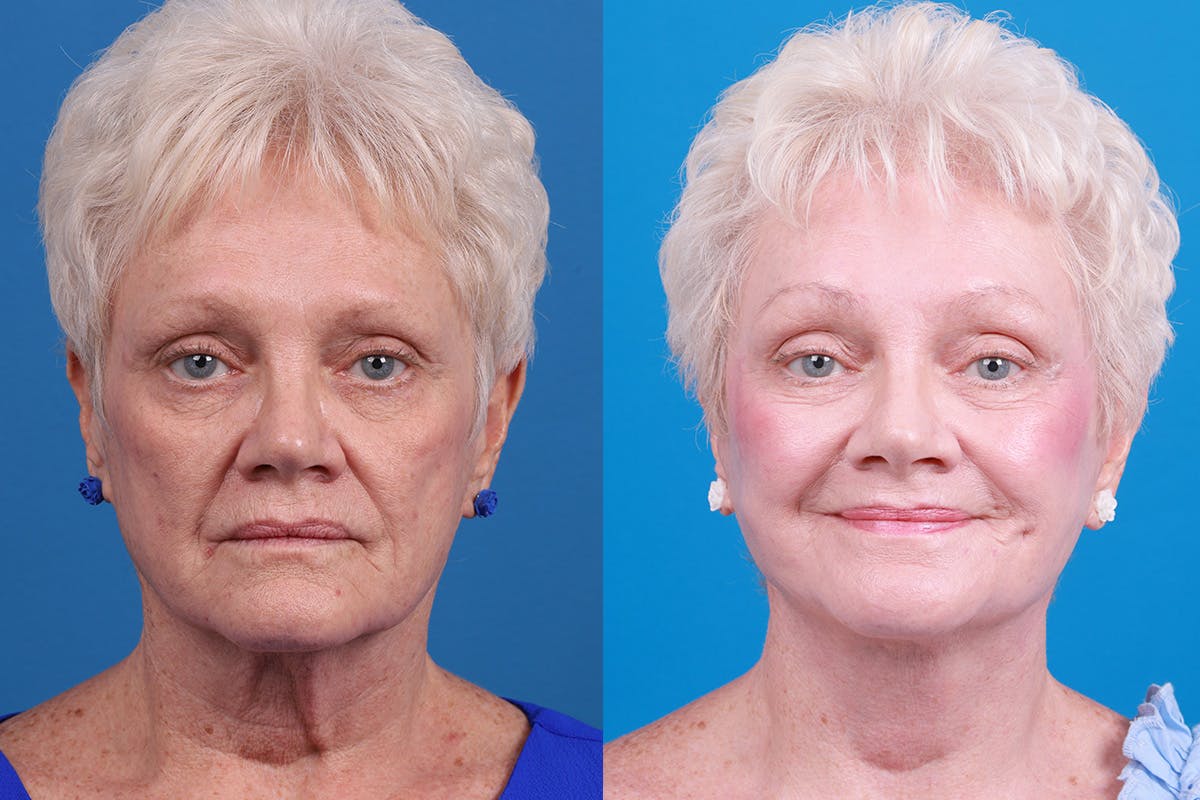 Skin Resurfacing Before & After Gallery - Patient 111904 - Image 1