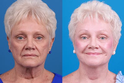 Facelift Before & After Gallery - Patient 246738 - Image 1