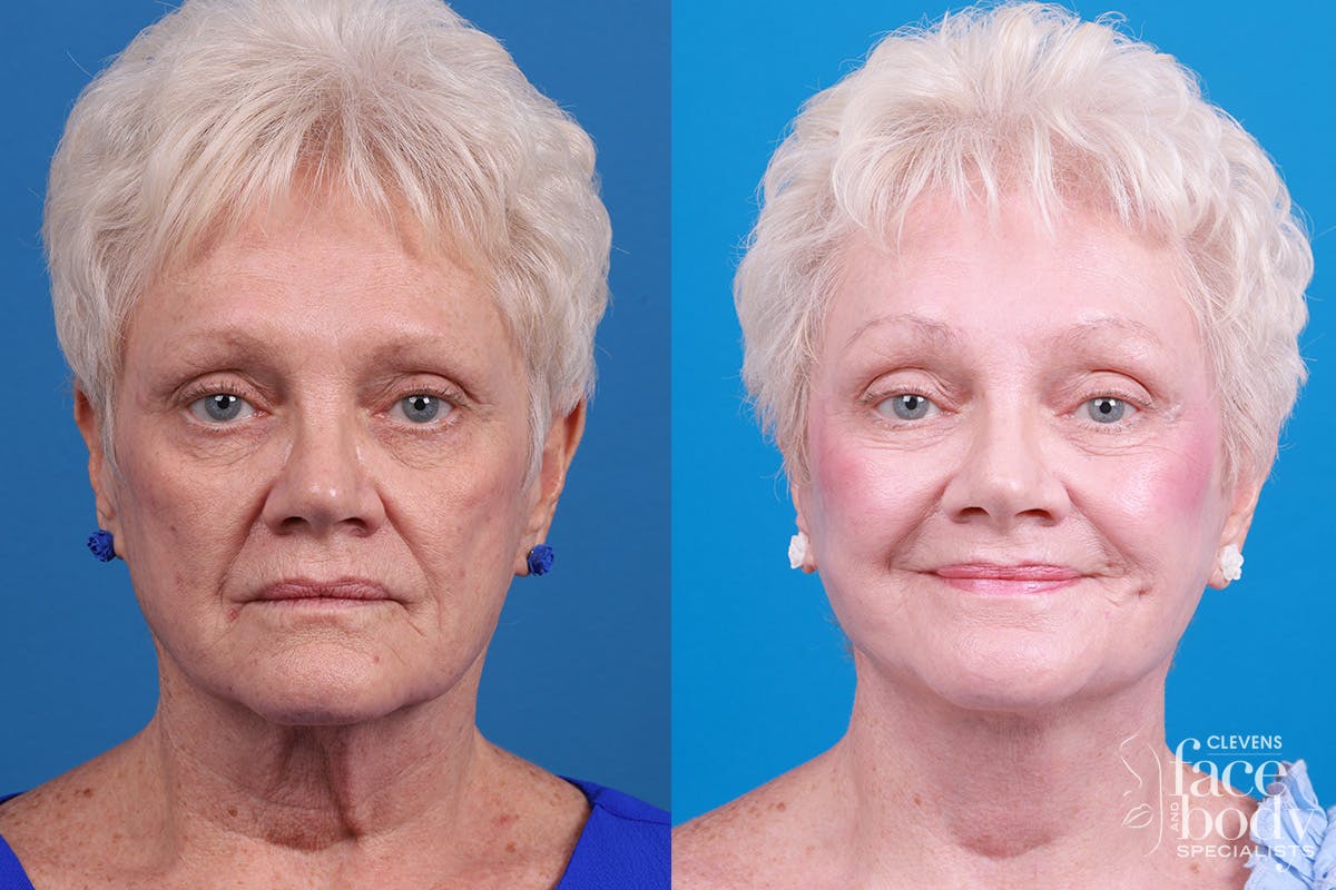 Skin Resurfacing Before & After Gallery - Patient 111904 - Image 1