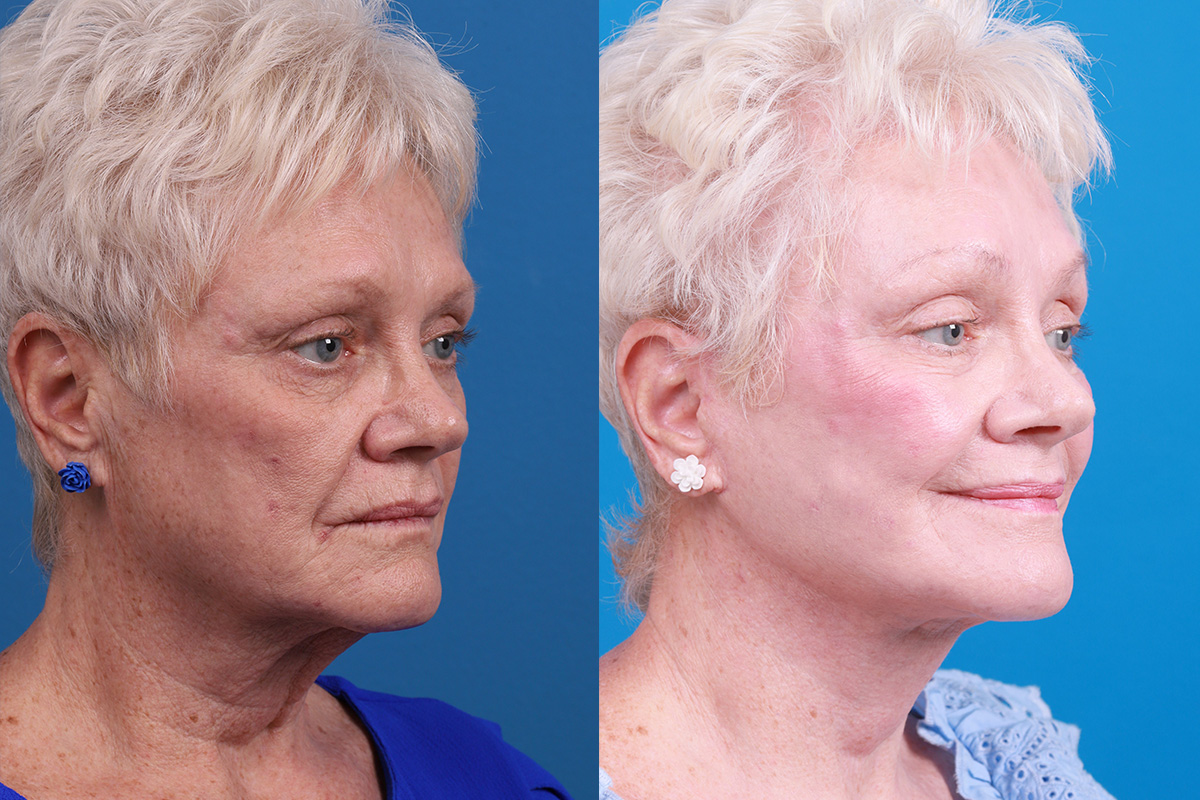 Brow Lift Before & After Gallery - Patient 171503 - Image 2