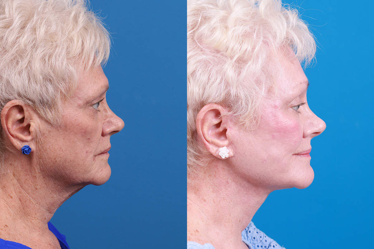 Brow Lift Before & After Gallery - Patient 171503 - Image 3