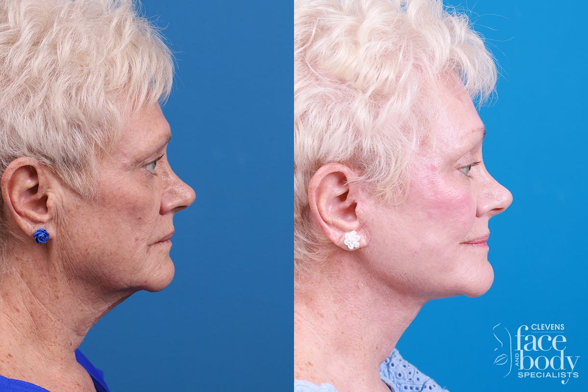 Skin Resurfacing Before & After Gallery - Patient 111904 - Image 3