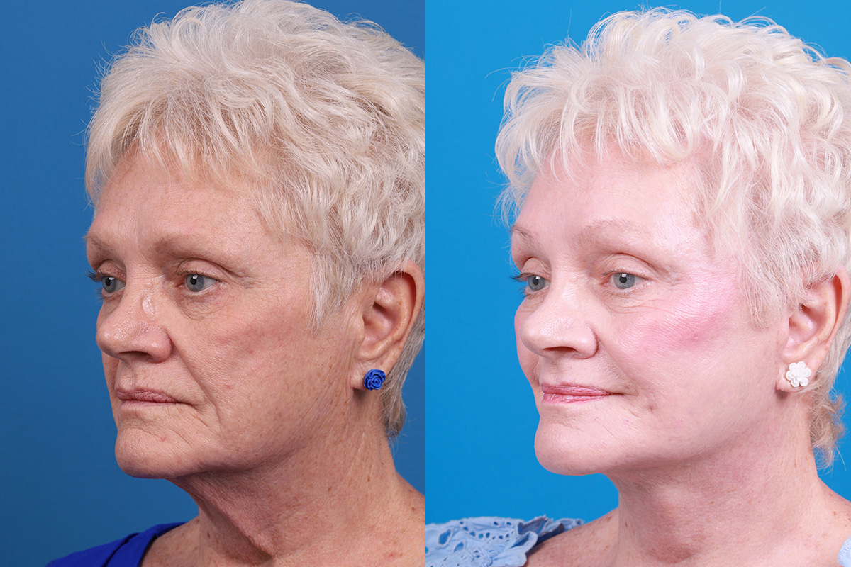 Brow Lift Before & After Gallery - Patient 171503 - Image 4
