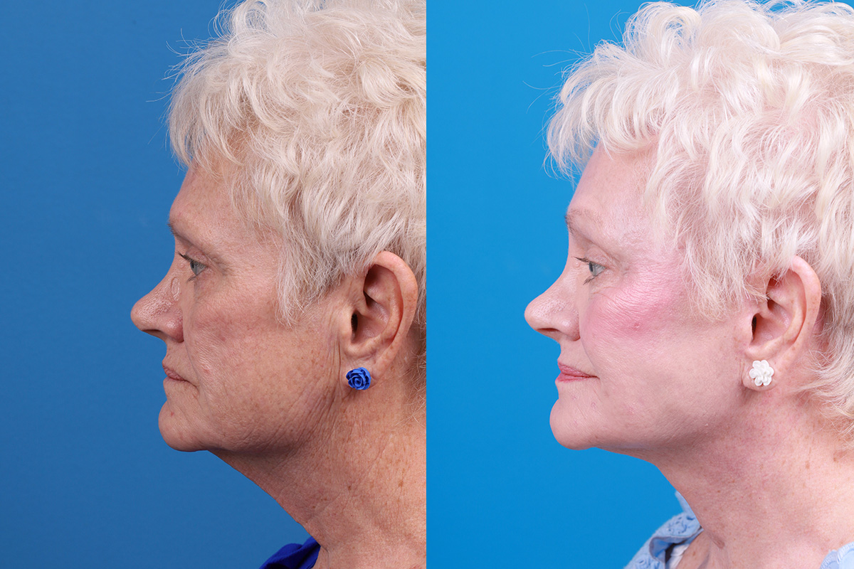 Brow Lift Before & After Gallery - Patient 171503 - Image 5