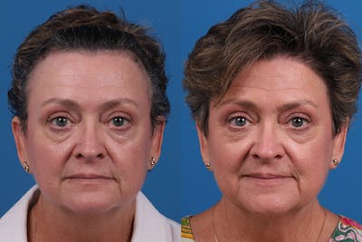 Hair Restoration Before & After Gallery - Patient 241763 - Image 1