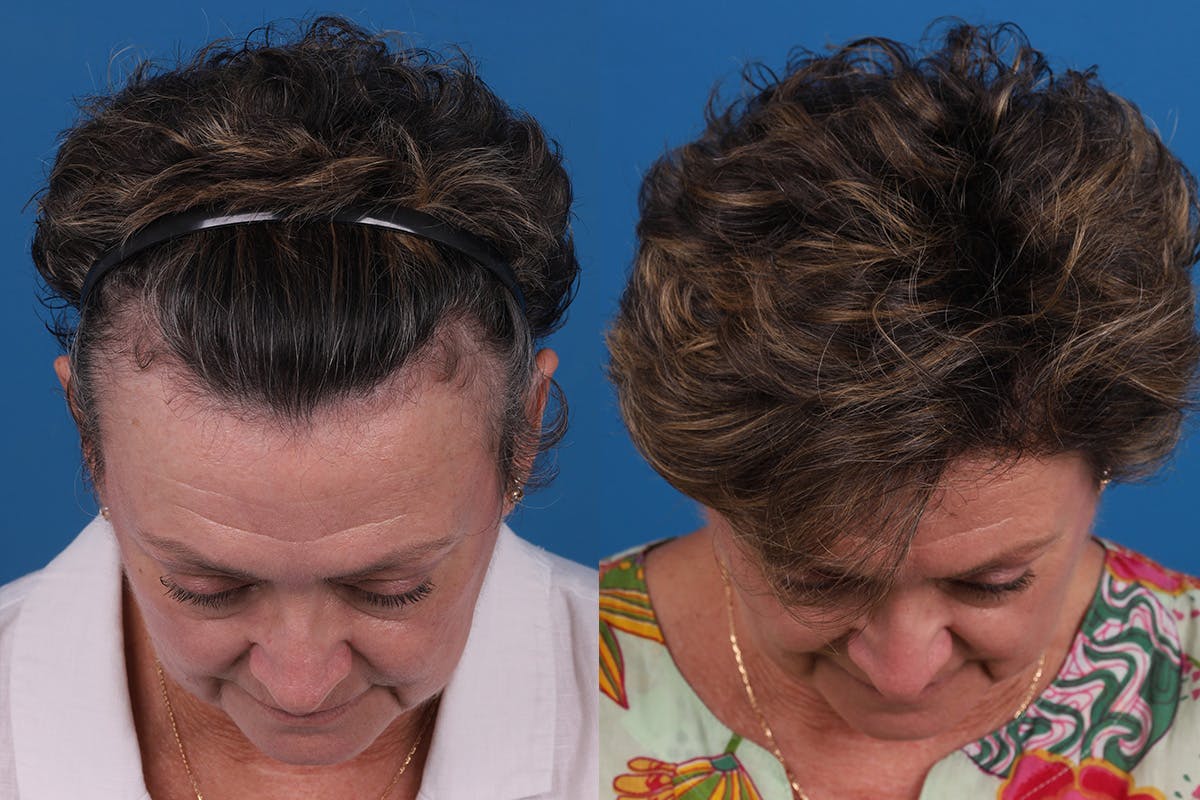 Hair Restoration Before & After Gallery - Patient 241763 - Image 2