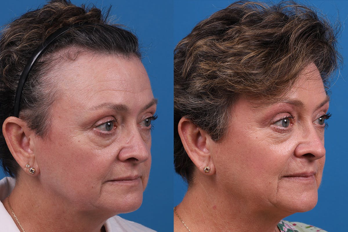 Hair Restoration Before & After Gallery - Patient 241763 - Image 3