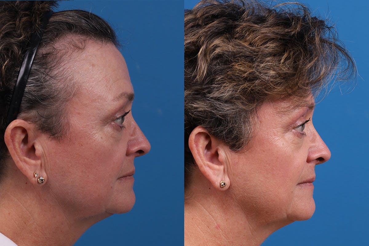 Hair Restoration Before & After Gallery - Patient 241763 - Image 4