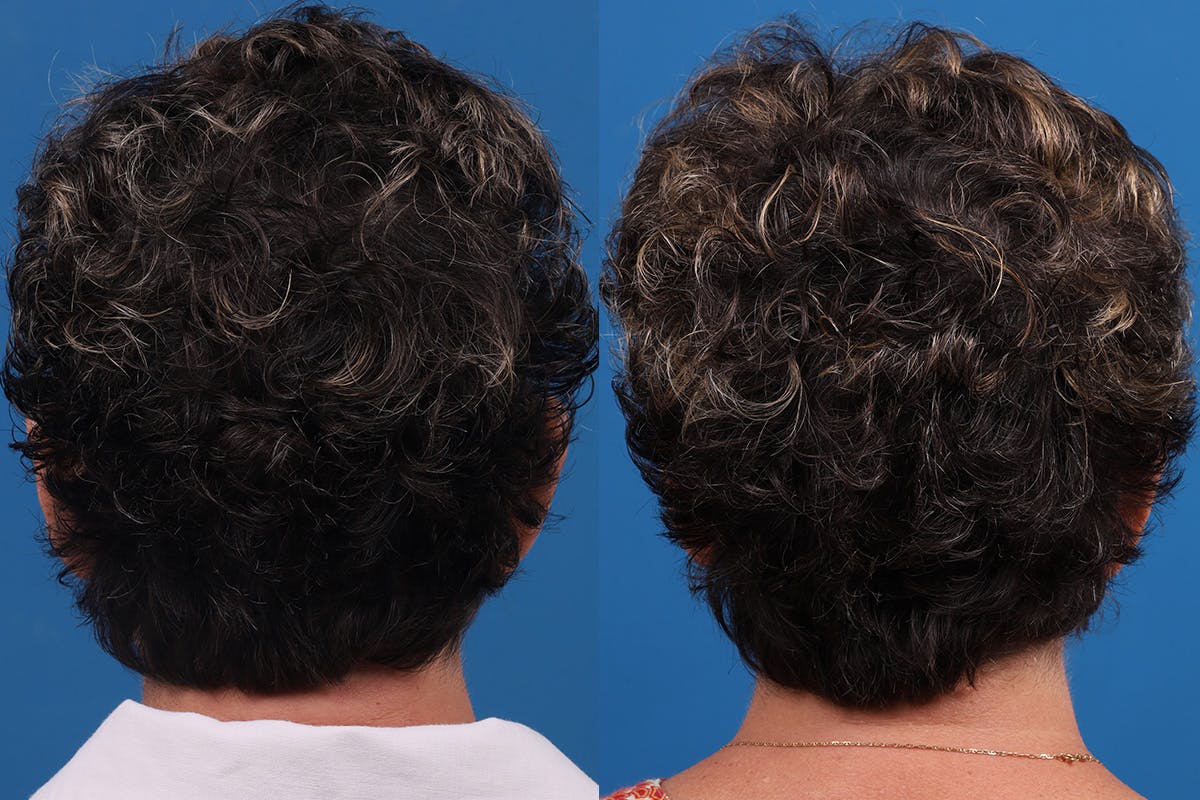 Hair Restoration Before & After Gallery - Patient 241763 - Image 5