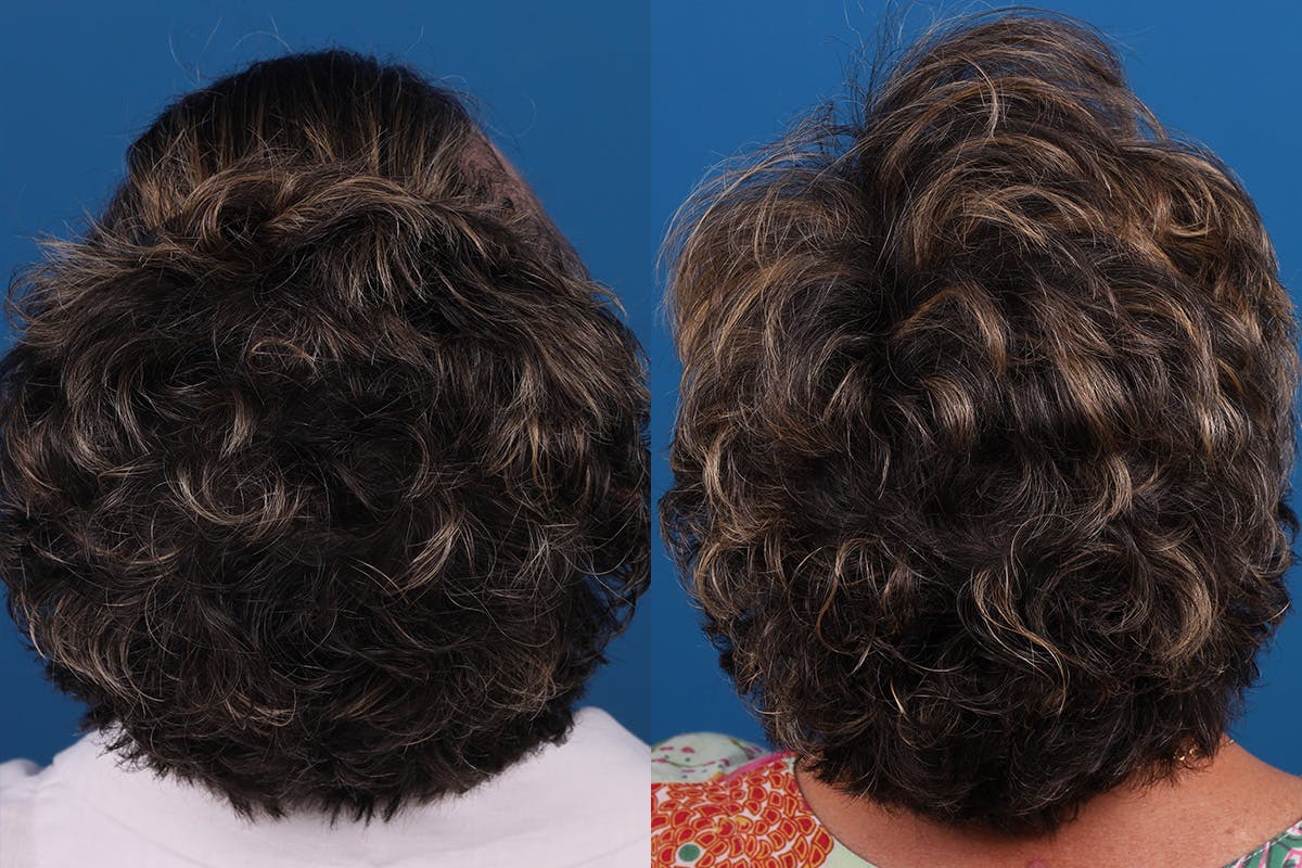 Hair Restoration Before & After Gallery - Patient 241763 - Image 6