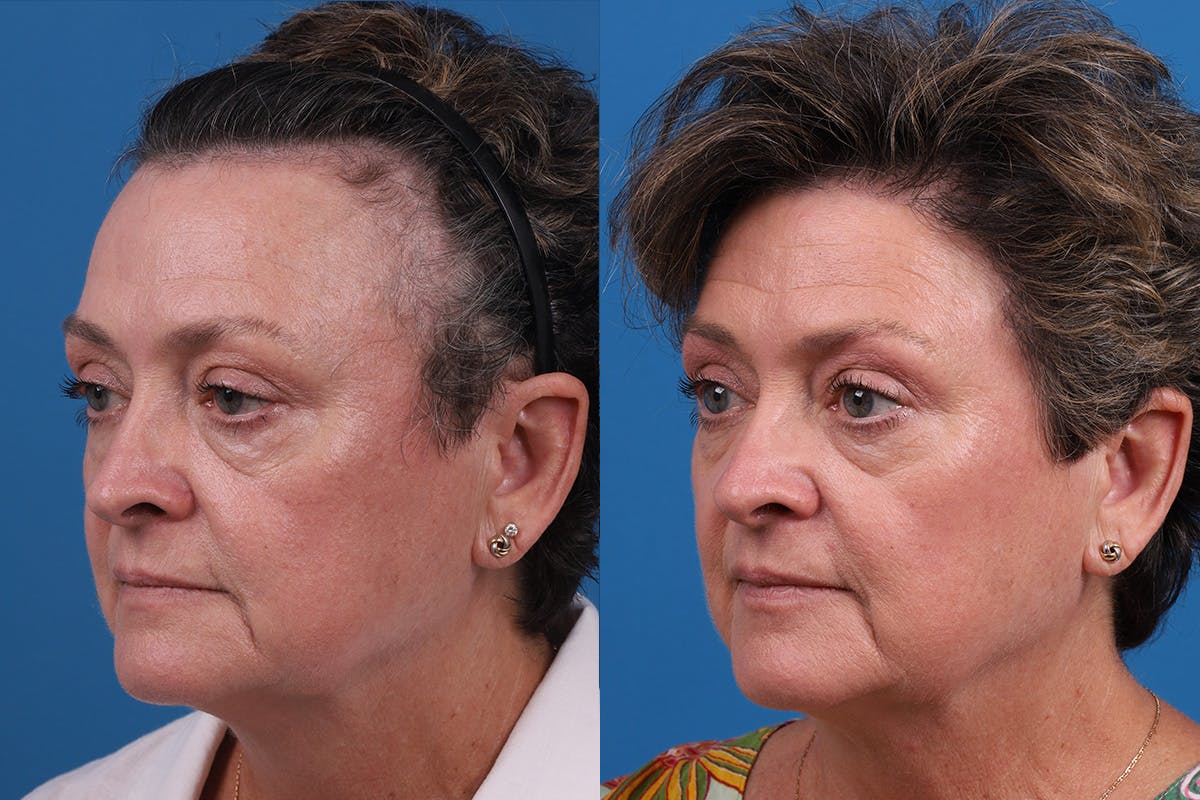 Hair Restoration Before & After Gallery - Patient 241763 - Image 7