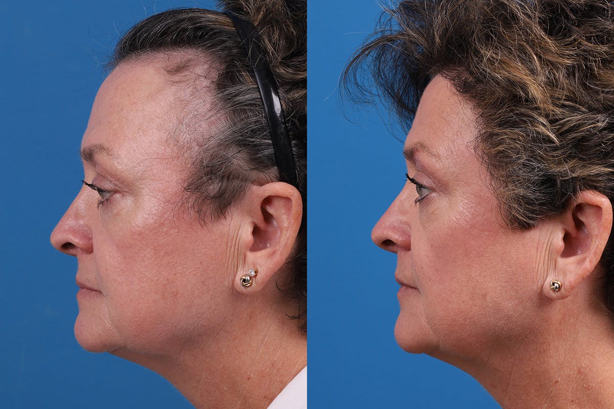 Hair Restoration Before & After Gallery - Patient 241763 - Image 8