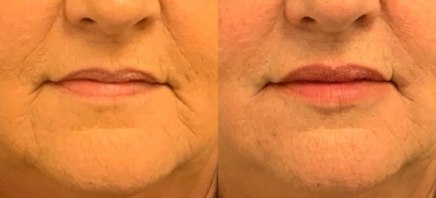 Lip Fillers Before & After Gallery - Patient 248937 - Image 1