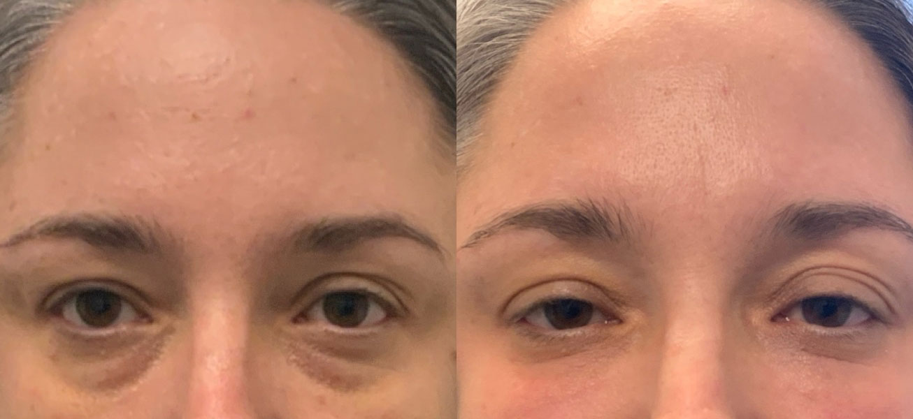 Dermal Fillers Before & After Gallery - Patient 413934 - Image 1