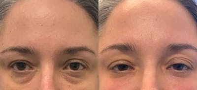Dermal Fillers Before & After Gallery - Patient 413934 - Image 1