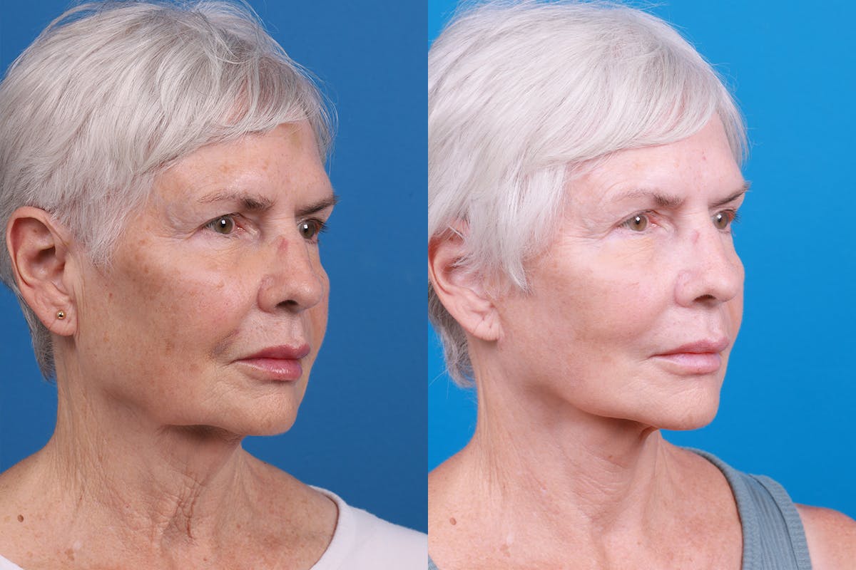 Facelift Before & After Gallery - Patient 118424 - Image 2