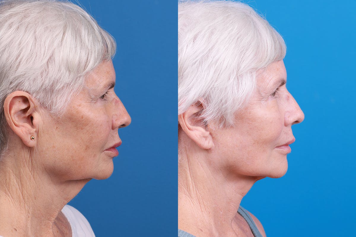 Facelift Before & After Gallery - Patient 118424 - Image 3
