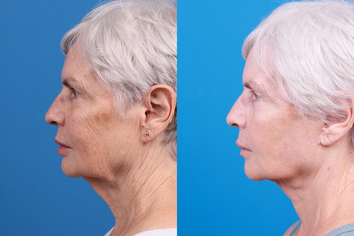Facelift Before & After Gallery - Patient 118424 - Image 4