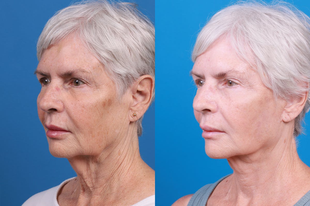 Facelift Before & After Gallery - Patient 118424 - Image 5