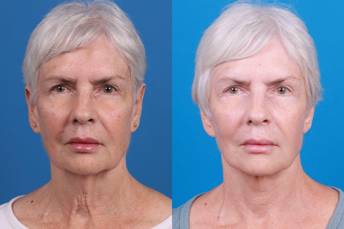 Facelift Before & After Gallery - Patient 118424 - Image 1