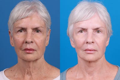 Facelift Before & After Gallery - Patient 118424 - Image 1