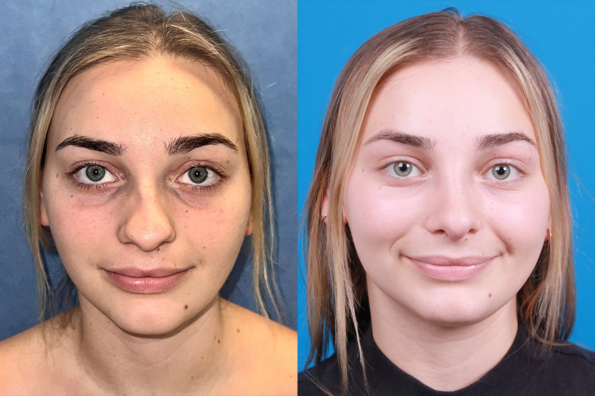 Rhinoplasty Before & After Gallery - Patient 362617 - Image 1