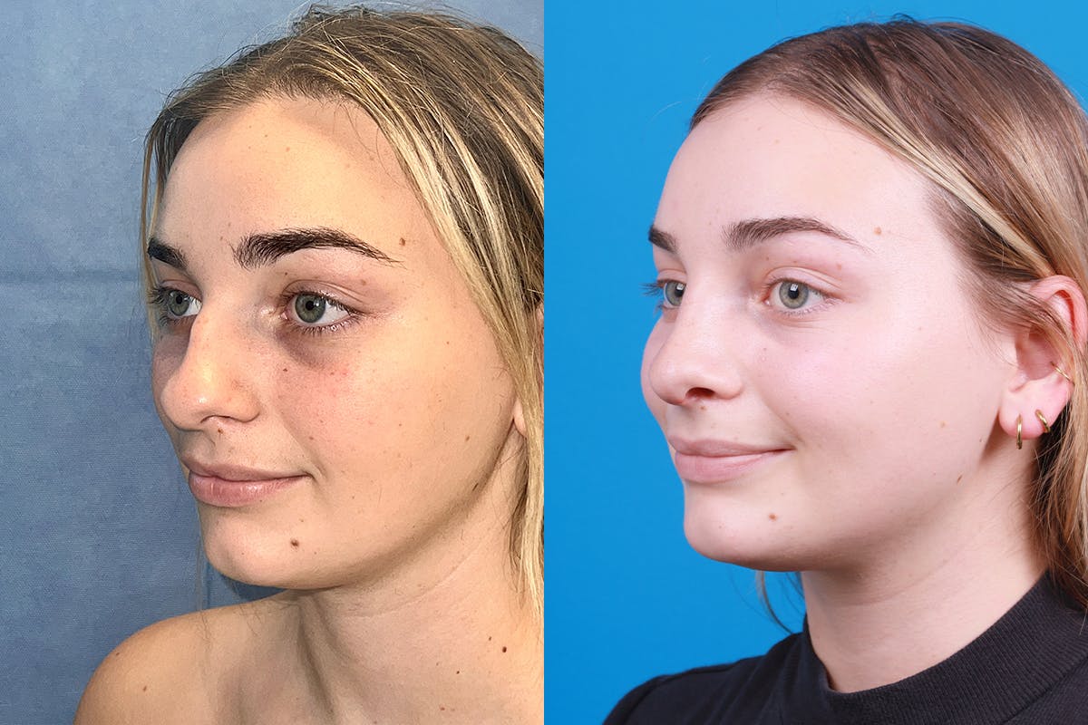 Rhinoplasty Before & After Gallery - Patient 362617 - Image 5