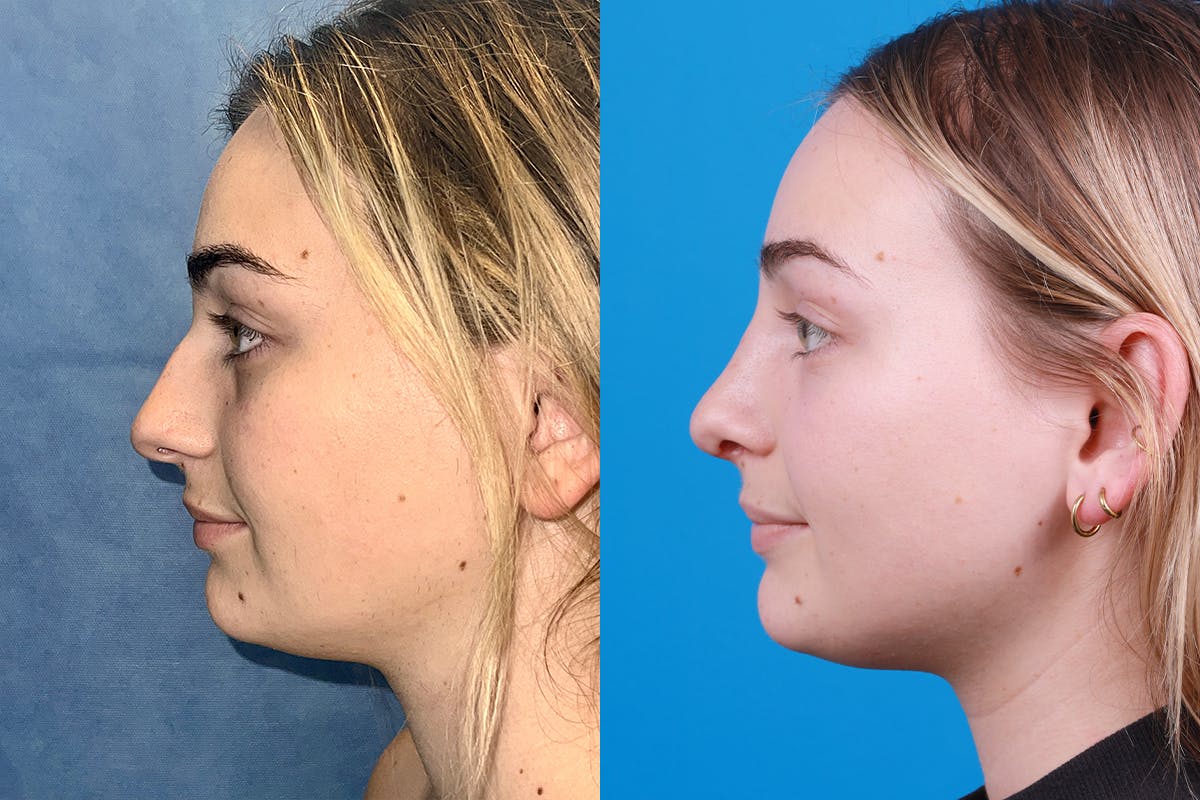 Rhinoplasty Before & After Gallery - Patient 362617 - Image 4