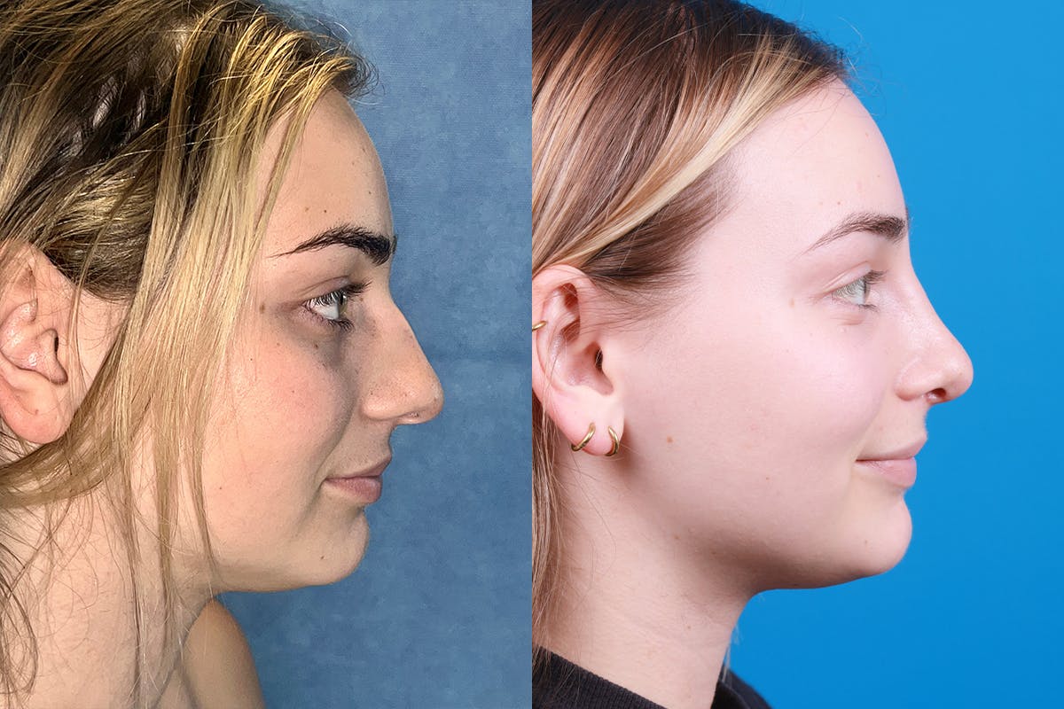 Rhinoplasty Before & After Gallery - Patient 362617 - Image 3