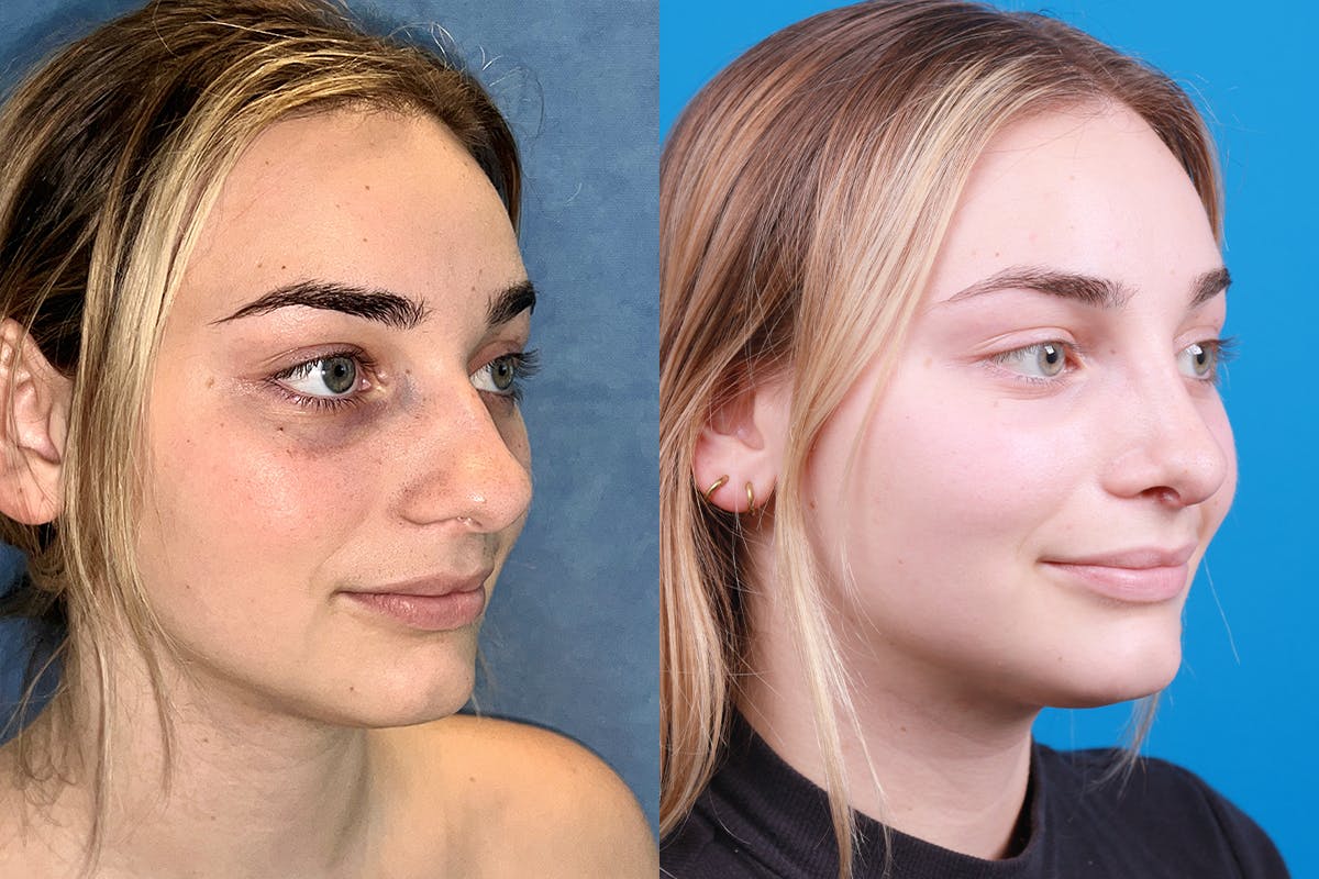 Rhinoplasty Before & After Gallery - Patient 362617 - Image 2