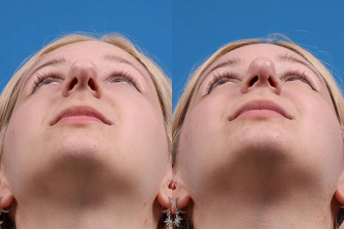 Rhinoplasty Before & After Gallery - Patient 577142 - Image 6