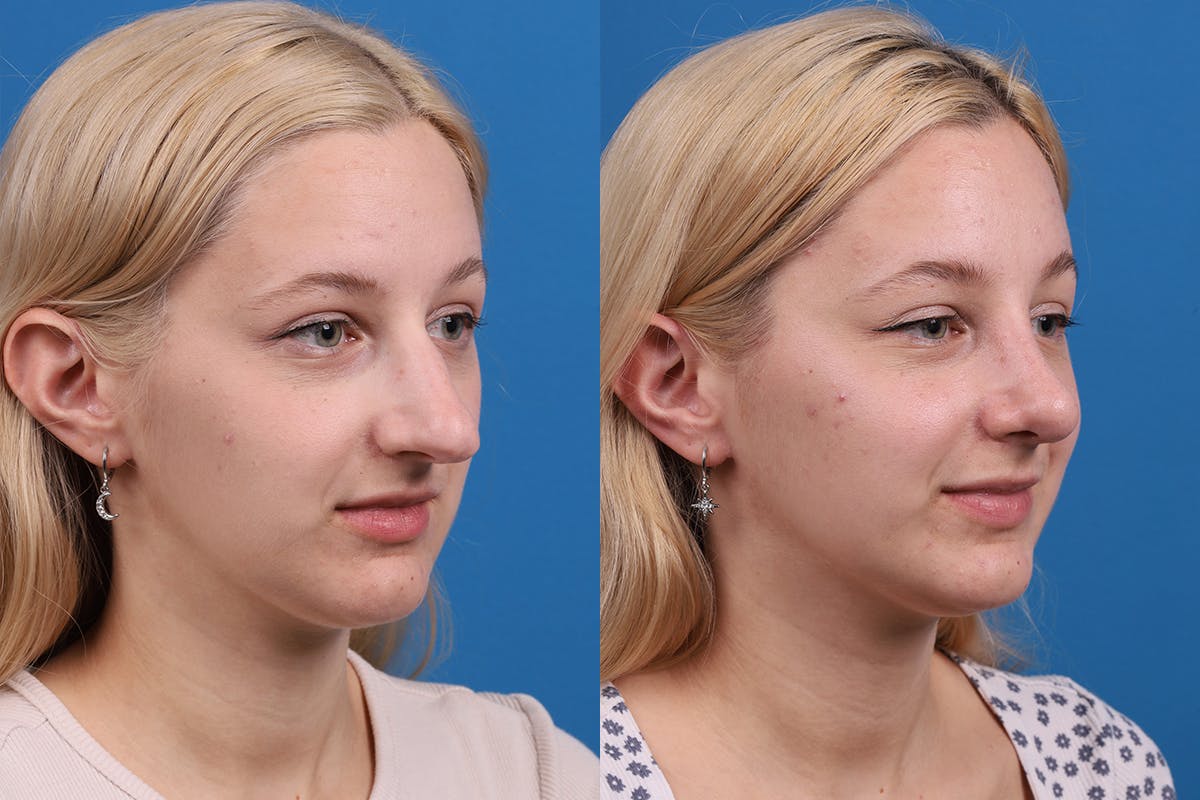 Rhinoplasty Before & After Gallery - Patient 577142 - Image 2