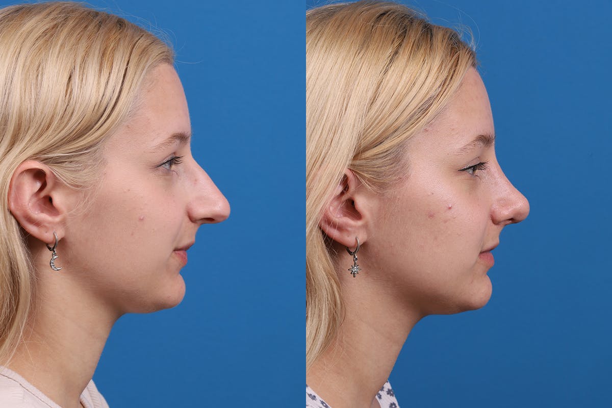 Rhinoplasty Before & After Gallery - Patient 577142 - Image 3