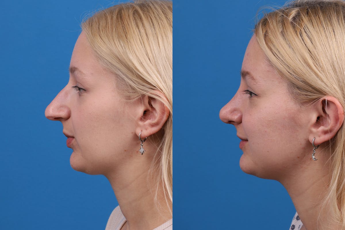 Rhinoplasty Before & After Gallery - Patient 577142 - Image 4
