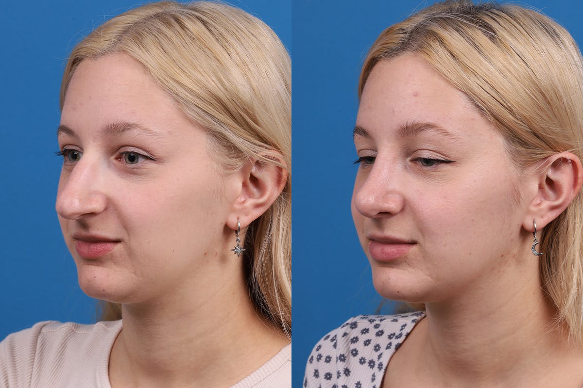 Rhinoplasty Before & After Gallery - Patient 577142 - Image 5