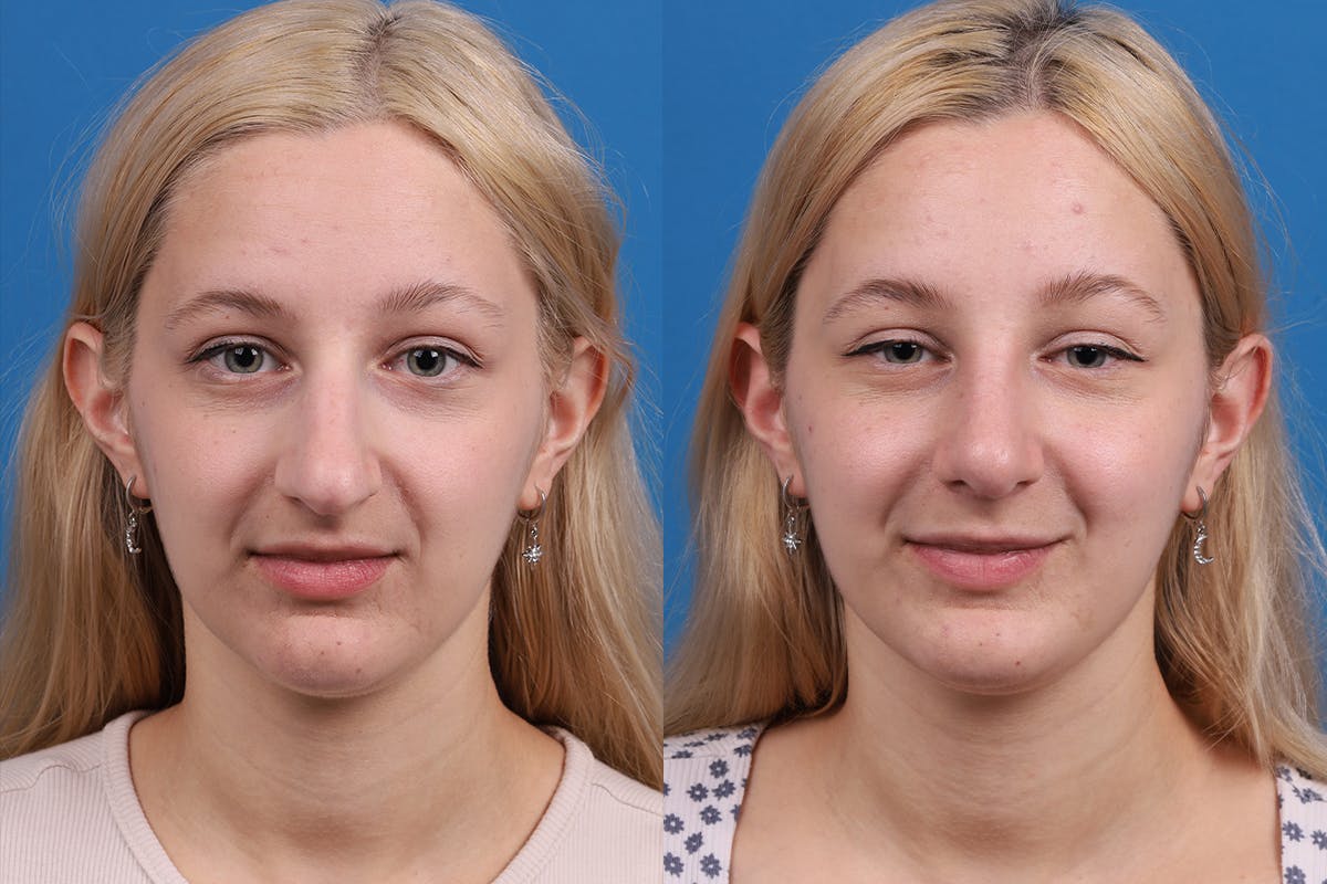 Rhinoplasty Before & After Gallery - Patient 577142 - Image 1