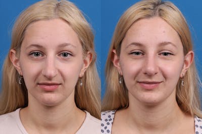 Rhinoplasty Before & After Gallery - Patient 577142 - Image 1