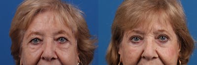 Eyelid Surgery Before & After Gallery - Patient 427022 - Image 1