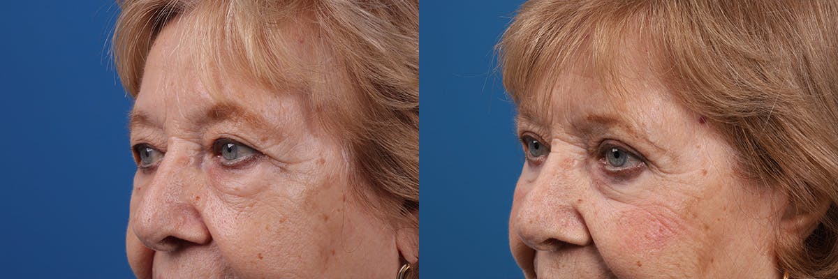 Eyelid Surgery Before & After Gallery - Patient 427022 - Image 5