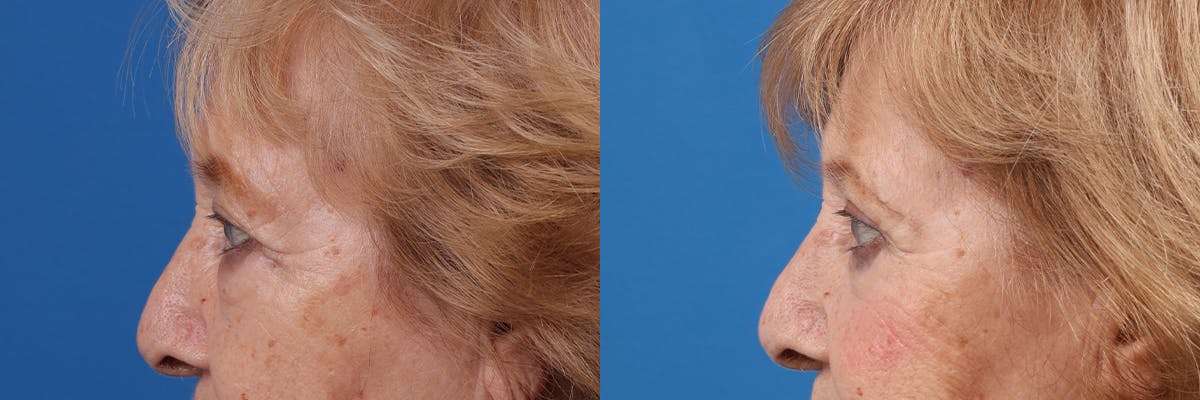 Eyelid Surgery Before & After Gallery - Patient 427022 - Image 4
