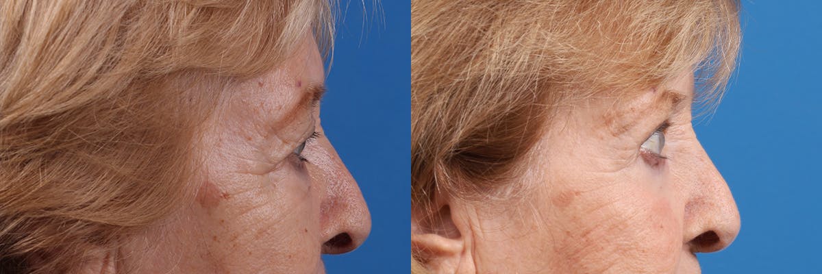 Eyelid Surgery Before & After Gallery - Patient 427022 - Image 3