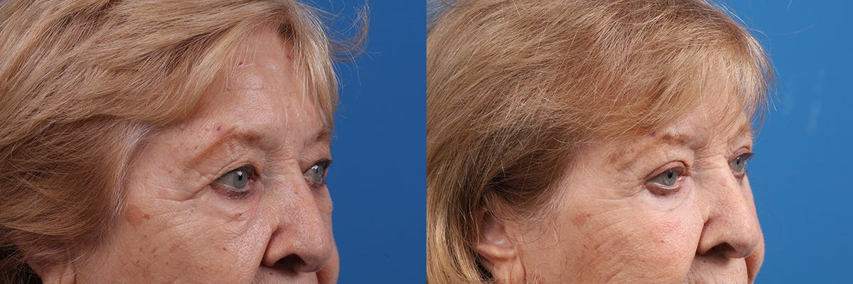Eyelid Surgery Before & After Gallery - Patient 427022 - Image 2