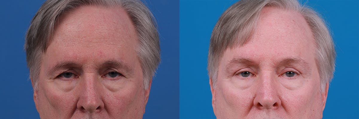 Eyelid Surgery Before & After Gallery - Patient 409336 - Image 1