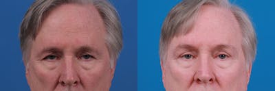 Eyelid Surgery Before & After Gallery - Patient 409336 - Image 1