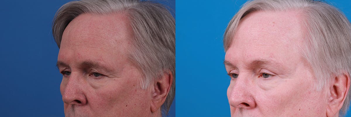 Eyelid Surgery Before & After Gallery - Patient 409336 - Image 5