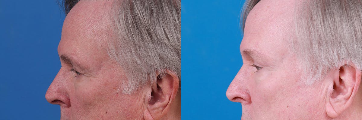 Eyelid Surgery Before & After Gallery - Patient 409336 - Image 4
