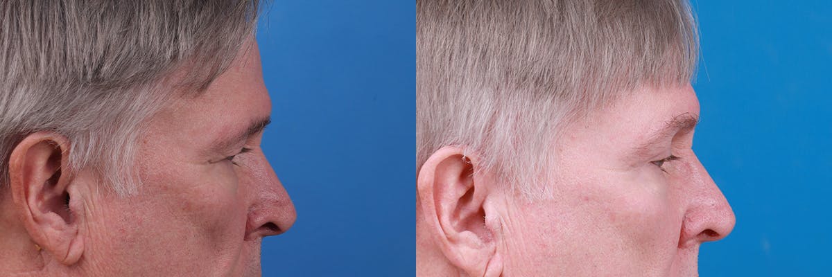 Eyelid Surgery Before & After Gallery - Patient 409336 - Image 3