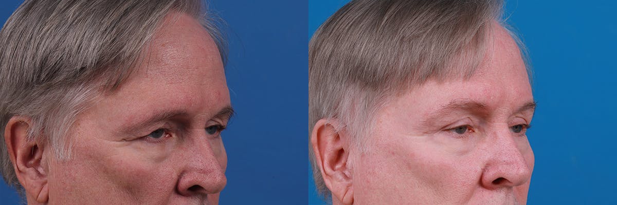 Eyelid Surgery Before & After Gallery - Patient 409336 - Image 2
